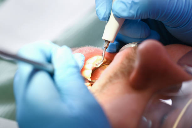 Best Emergency Tooth Extraction  in Mmerce City, CO