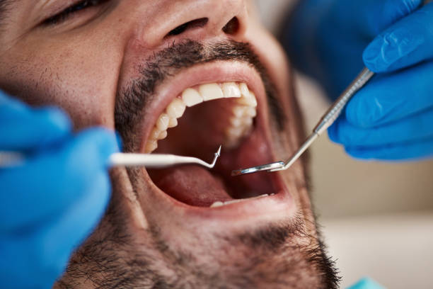 Best Dentist for Tooth Abscess  in Mmerce City, CO